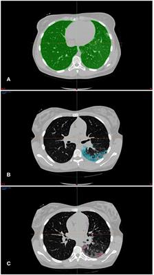 Quantitative Assessment of Parenchymal Involvement Using 3D Lung Model in Adolescent With Covid-19 Interstitial Pneumonia